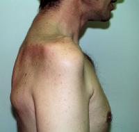 Steroid injection in neck side effects